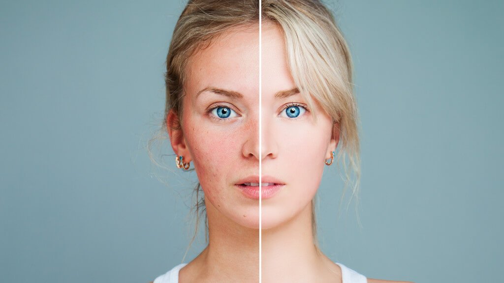 Czerwone przebarwienia na twarzy