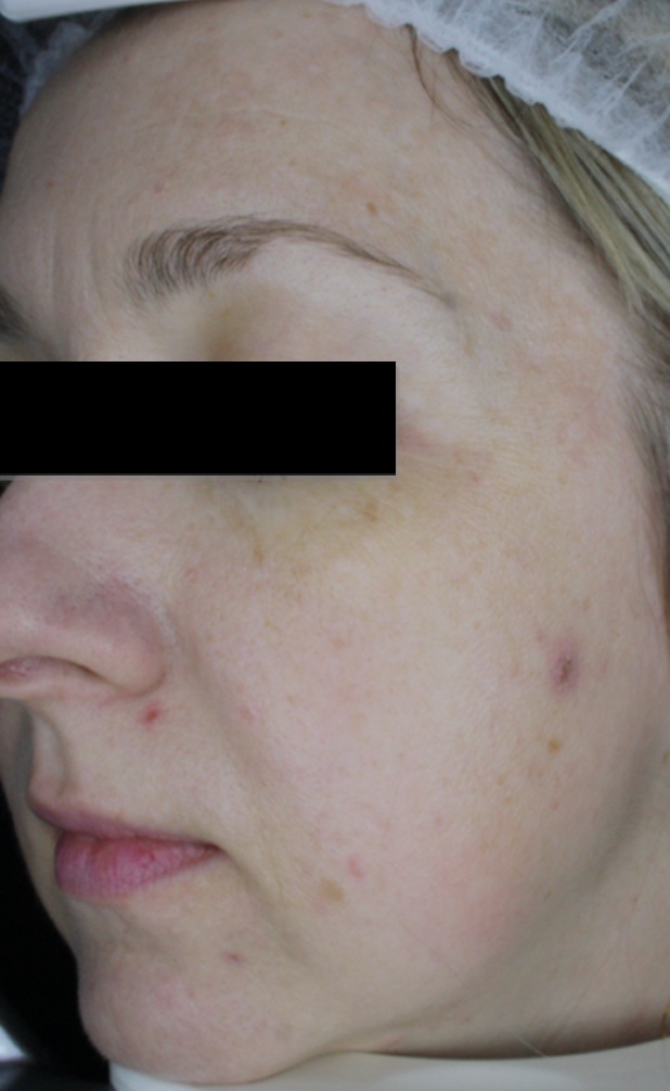 Zdjęcie z badania serum Senelle: ta sama uczestniczka przed i po 8 tygodniach. Po 8 tygodniach regularnego stosowania serum