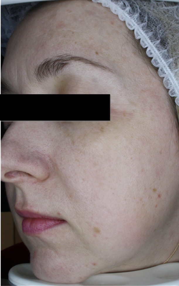 Zdjęcie z badania serum Senelle: ta sama uczestniczka przed i po 8 tygodniach. Przed rozpoczęciem stosowania serum