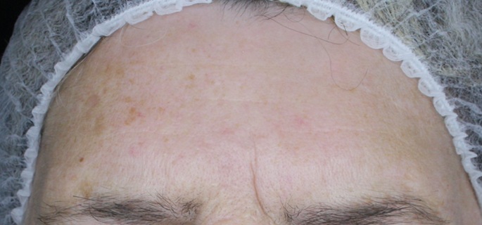 Zdjęcie z badania serum Senelle: ta sama uczestniczka przed i po 8 tygodniach. Po 8 tygodniach regularnego stosowania serum