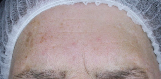 Zdjęcie z badania serum Senelle: ta sama uczestniczka przed i po 8 tygodniach. Przed rozpoczęciem stosowania serum
