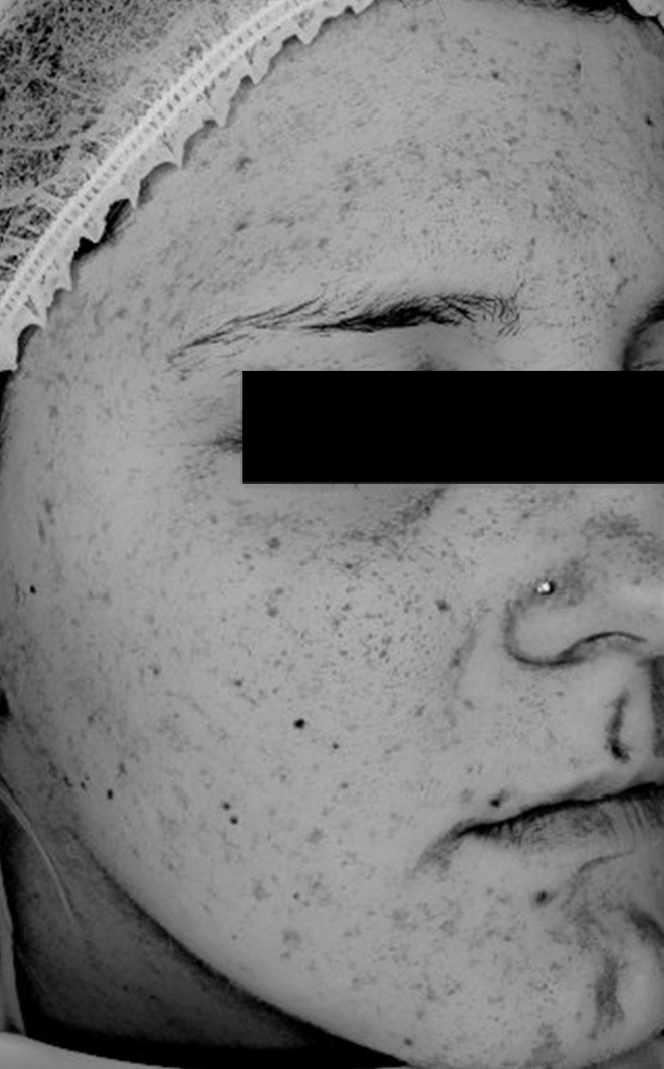 Zdjęcie z badania serum Senelle: ta sama uczestniczka przed i po 8 tygodniach. Po 8 tygodniach regularnego stosowania serum