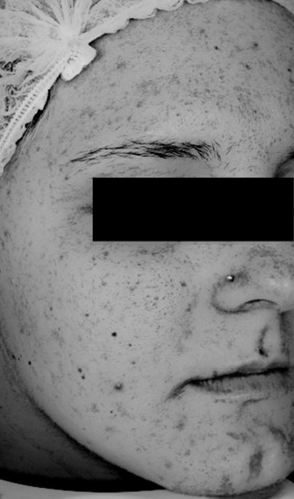 Zdjęcie z badania serum Senelle: ta sama uczestniczka przed i po 8 tygodniach. Przed rozpoczęciem stosowania serum