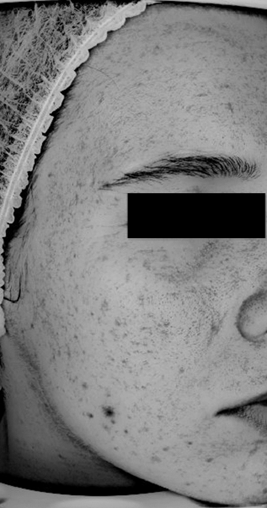 Zdjęcie z badania serum Senelle: ta sama uczestniczka przed i po 8 tygodniach. Po 8 tygodniach regularnego stosowania serum