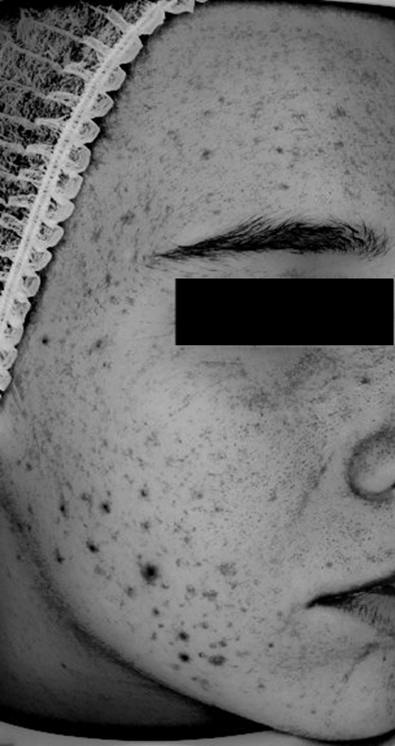 Zdjęcie z badania serum Senelle: ta sama uczestniczka przed i po 8 tygodniach. Przed rozpoczęciem stosowania serum