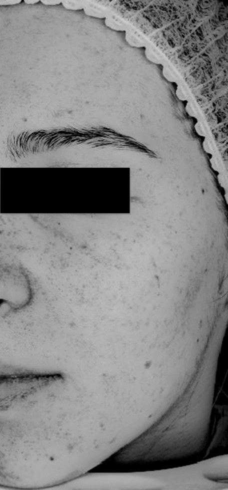 Zdjęcie z badania serum Senelle: ta sama uczestniczka przed i po 8 tygodniach. Po 8 tygodniach regularnego stosowania serum