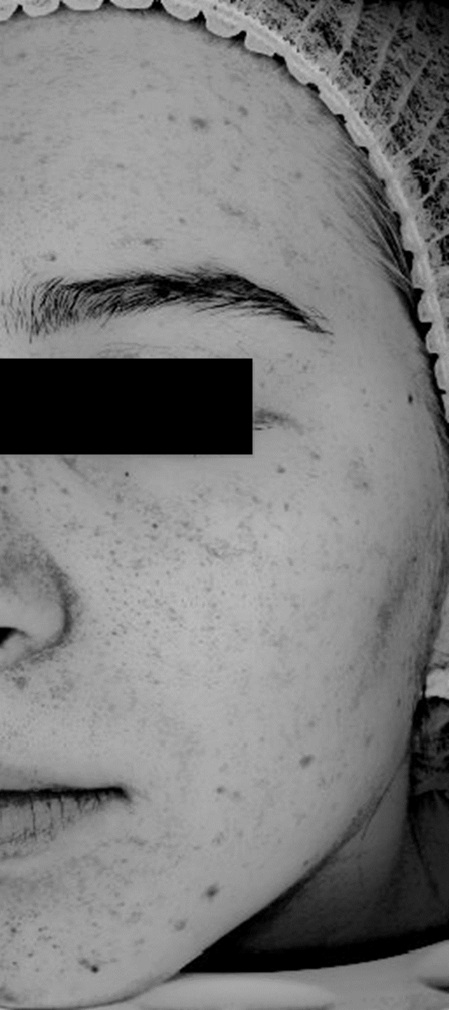 Zdjęcie z badania serum Senelle: ta sama uczestniczka przed i po 8 tygodniach. Przed rozpoczęciem stosowania serum